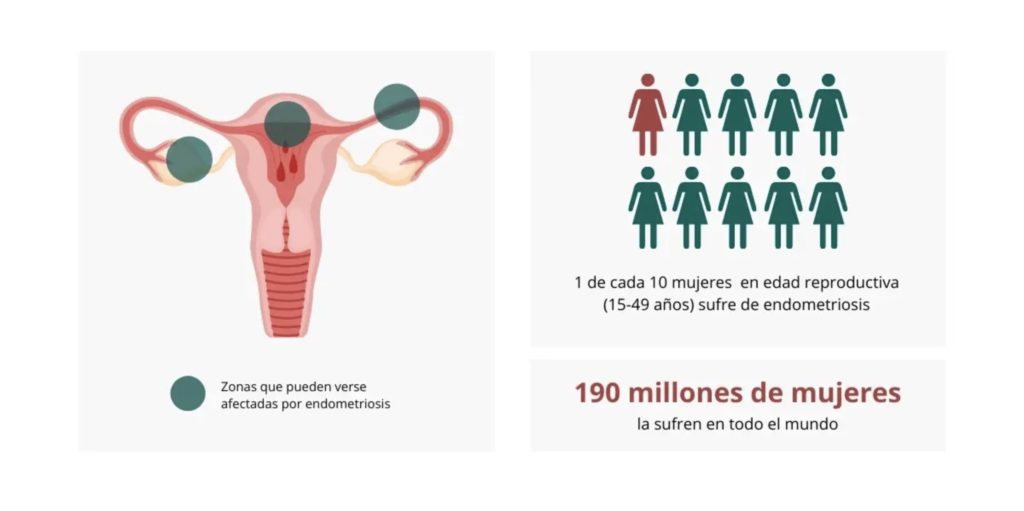 endometriosis